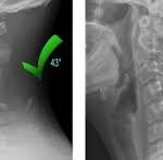 Servikal Omurganın Anatomisi ve servikal lordoz eğrisini gösteren boyun omurgası görseli