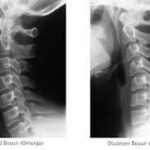 Servikal Omurganın Anatomisi ve servikal lordoz eğrisini gösteren boyun omurgası görseli