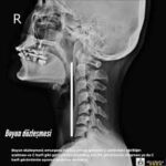 Servikal Omurganın Anatomisi ve servikal lordoz eğrisini gösteren boyun omurgası görseli
