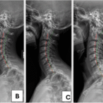 Servikal Omurganın Anatomisi ve servikal lordoz eğrisini gösteren boyun omurgası görseli