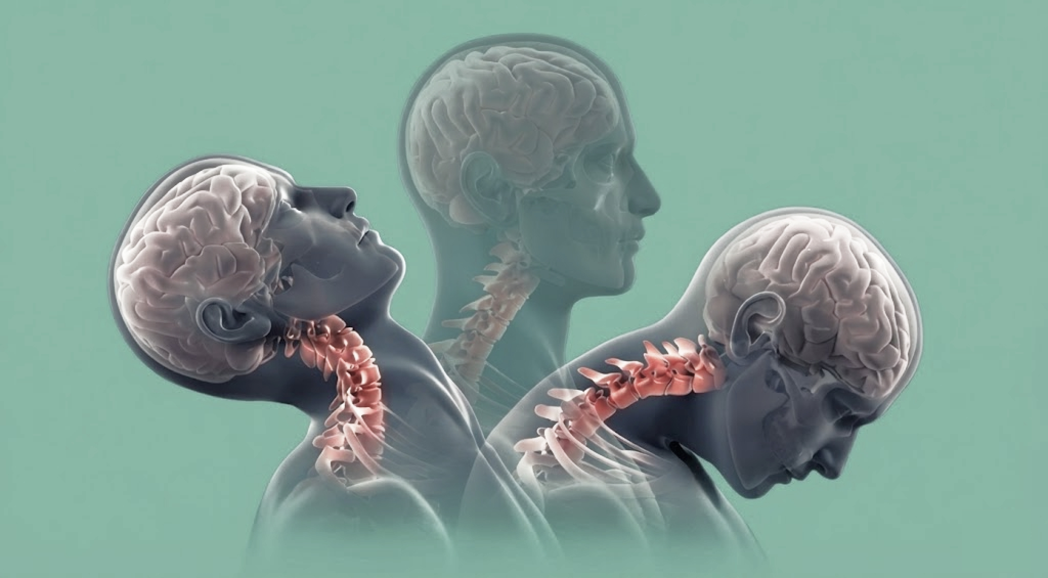 Whiplash (boyun incinmesi) sırasında başın öne ve arkaya savrulmasını gösteren illüstrasyon